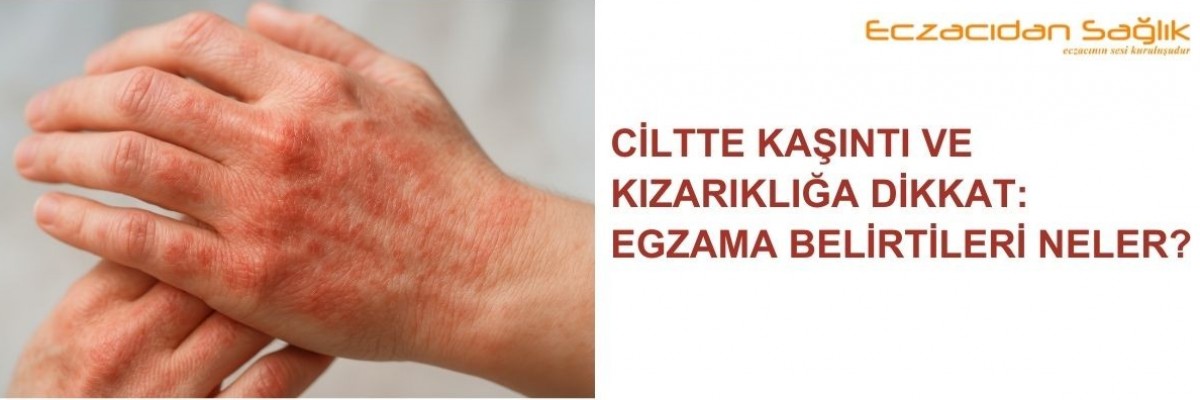 Egzama Belirtileri Neler?