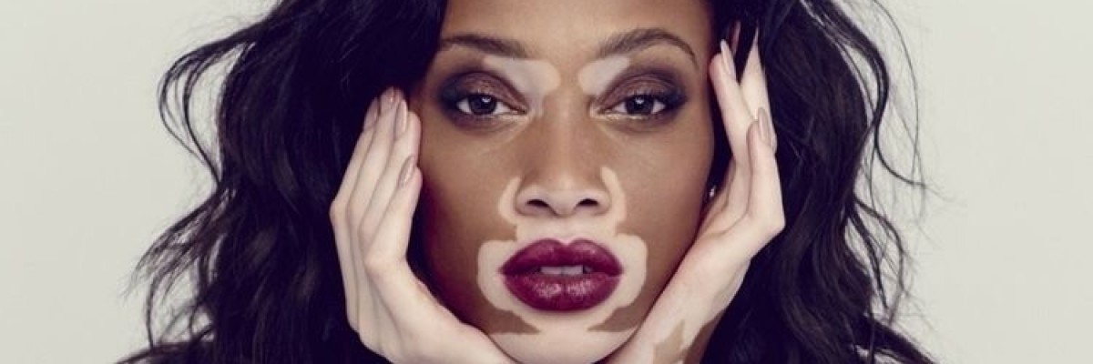 Vitiligo