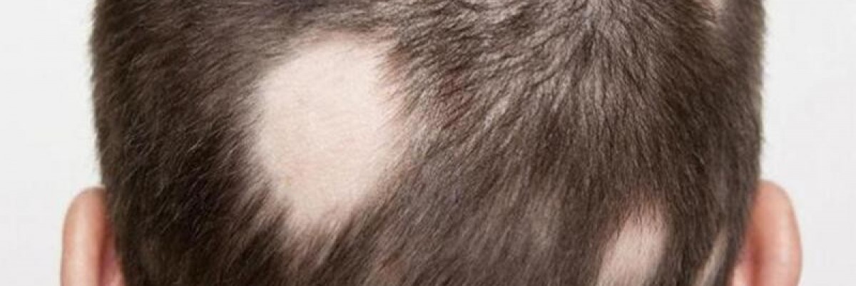 Alopesi Areata: Saçkıran