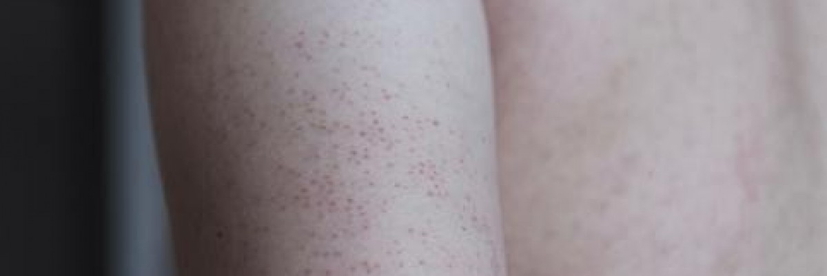 Keratosis Pilaris