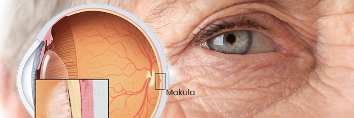 Epiretinal membran hastalığı görme kaybına yol açabilir!